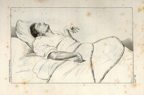 J. É. D. Esquirol - Maladies mentales. 1838.